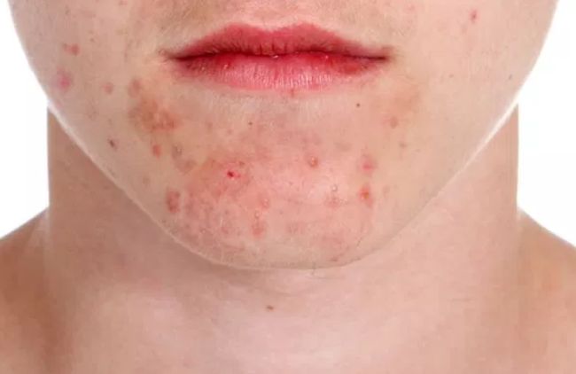 治疗痤疮、牛皮癣等皮肤病